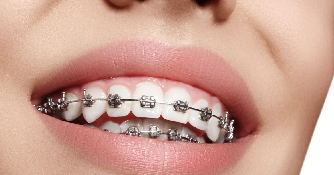 Как питаться после установки брекетов, рекомендации стоматолога