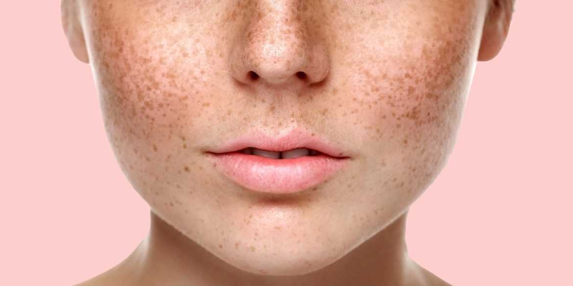 уход за кожей с гиперпигментацией в Алматы